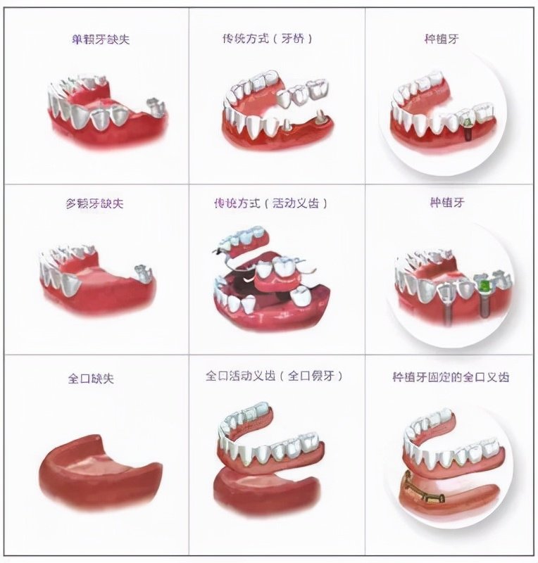 假牙的种类